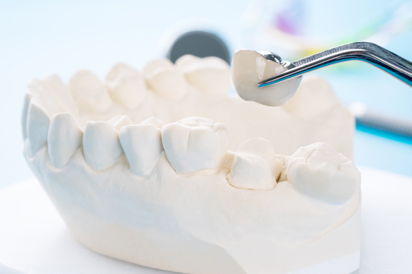 How Dental Crowns Are Used With Dental Fillings